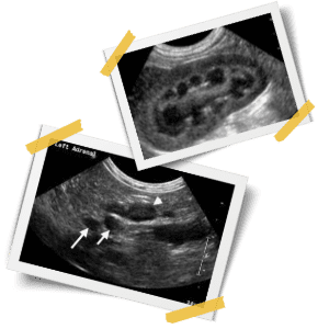 Ultrasound pics Pirnce William
